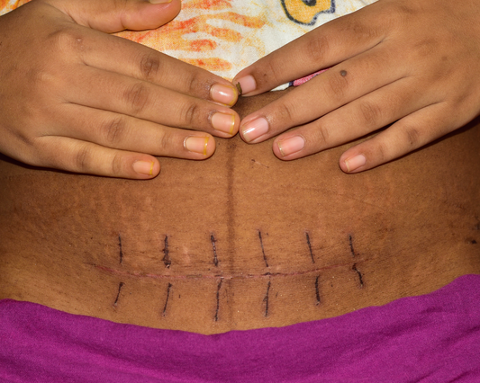 Scars of Strength: Walk Your Path To C-Section Empowerment